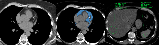Cuantificaci&oacute;n de la grasa epic&aacute;rdica, evaluaci&oacute;n de la calcificaci&oacute;n coronaria e identificaci&oacute;n de esteatosis hep&aacute;tica mediante TC de t&oacute;rax convencional. N&oacute;tese la presencia de calcificaci&oacute;n en la arteria descendente anterior, con incremento del volumen de la grasa epic&aacute;rdica (en azul), y esteatosis hep&aacute;tica grave (10 UH, con cociente h&iacute;gado/bazo de 0,21).