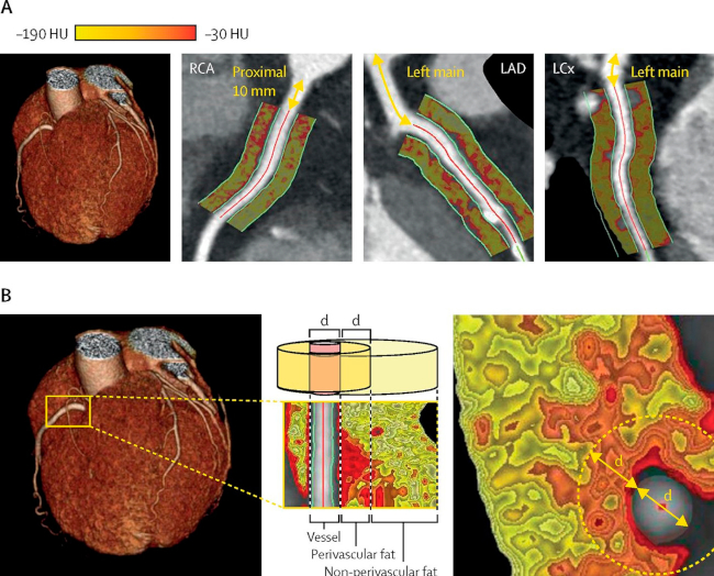 A. Atenuaci&oacute;n de la grasa pericoronaria (FAI) de los segmentos proximales de los tres vasos coronarios epic&aacute;rdicos principales, con los mapas de FAI correspondientes. B. Ejemplo del fenotipo de la FAI pericoronaria alrededor del tercio proximal de la arteria coronaria derecha. Se defini&oacute; a la grasa pericoronaria como a la grasa localizada a una distancia radial igual al di&aacute;metro (d) del vaso. HU: unidades Hounsfield, LAD: arteria descendente anterior, LCx: arteria circunfleja, RCA: coronaria derecha. (De: Oikonomou EK, et al. Lancet 2018, 392(10151):929-939).