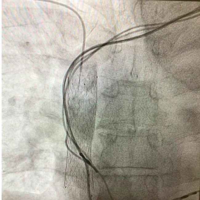 Detalle de la cavografía; se observan los distintos cables del marcapasos y el stent permeable en la vena cava superior.