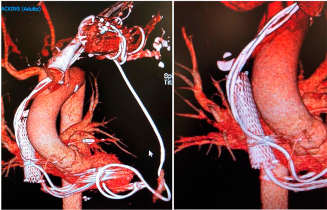 Reconstrucción tridimensional de la tomografía multicorte; se observan los distintos cables de marcapasos y el stent implantado en la vena cava superior (detalle de los cables atrapados en la imagen de la derecha).