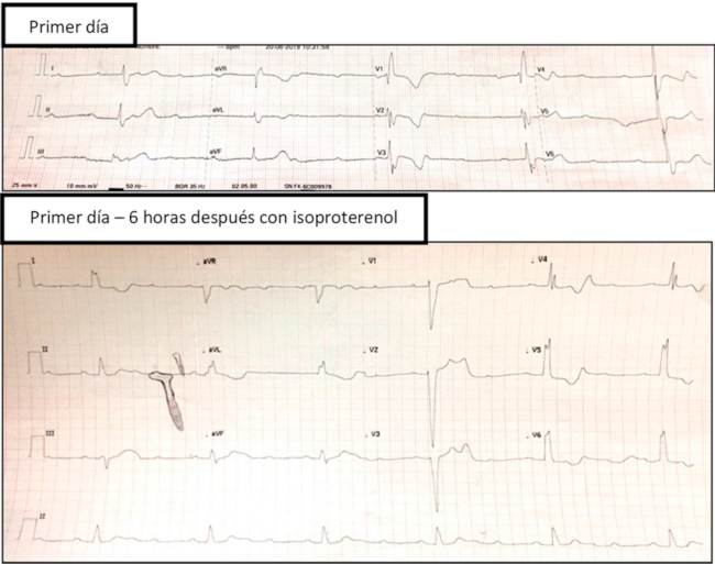 ECG que evidencia bloqueo aur&iacute;culo-ventricular completo con escape con imagen de BCRD a una frecuencia card&iacute;aca (FC) de 25 lpm. 1b. ECG a las 6 h, bajo los efectos del isoproterenol: BAV 3:1.