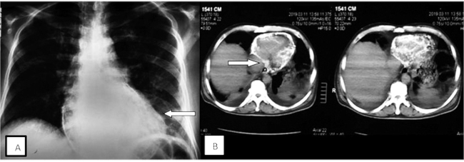 A) radiograf&iacute;a t&oacute;rax. B) tomograf&iacute;a de t&oacute;rax con calcificaci&oacute;n difusa del pericardio. Las flechas blancas se&ntilde;alan la calcificaci&oacute;n