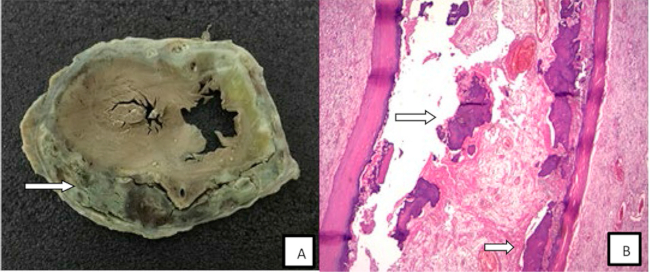 A) Imagen macrosc&oacute;pica de coraz&oacute;n explantado; con un pericardio gravemente calcificado. B) Imagen de la microscop&iacute;a &oacute;ptica con infiltrado inflamatorio, sin granulomas, y metaplasia osea.