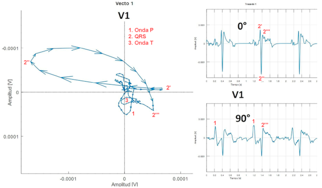 Trazado ortogonal al nivel de la localizaci&oacute;n de la precordial unipolar V1 en el que se muestra el eje derecha-izquierda (0&deg;), el eje cefalocaudal (90&deg;) y un bucle representativo del plano frontal local en la localizaci&oacute;n del electrodo precordial V1. En el eje 90&ordm; se muestra con claridad la onda P. La presencia de dos ondas simult&aacute;neas colabora con la identificaci&oacute;n y la medici&oacute;n en tiempo y amplitud de los fen&oacute;menos el&eacute;ctricos. 6