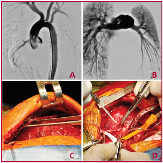 Caso 1. A: mapeo coronario, ausencia de nacimiento de coronaria izquierda; B: mapeo de arteria pulmonar; C: preparaci&oacute;n de mamaria interna izquierda (MII) con t&eacute;cnica esqueletizada; D: realizaci&oacute;n de bypass MII a arteria descendente anterior (DA).