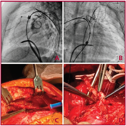 Caso 2. A: mapeo coronario; B: mapeo de MII in situ; C: preparaci&oacute;n de MII con t&eacute;cnica esqueletizada; D: realizaci&oacute;n de bypass MII a DA.