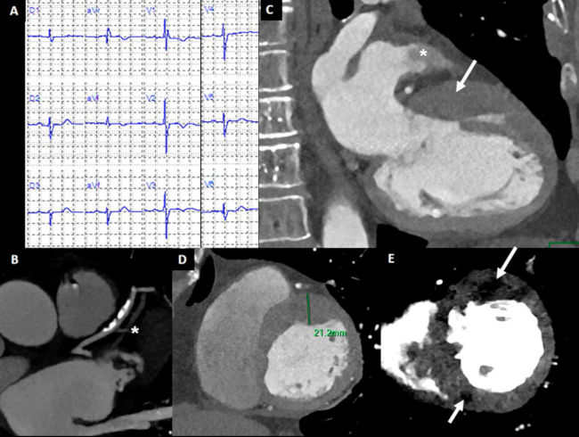 (A) ECG con intervalo PR en límite superior; eje eléctrico indeterminado con complejos QRS (de duración normal) de bajo voltaje en las derivaciones de los miembros; ondas Q en DII-DIII-aVF sugestivas de inactivación inferior; bloqueo incompleto de la rama derecha atípico, por la presencia en V1 de R < que R inicial; decrecimiento anormal de ondas R de precordiales derechas a izquierdas; alteración ST-T en DI, a VL y V2-V4; duración QTc normal. (B-E) Fase arterial de la adquisición (gatillado ECG retrospectivo). (B) Ateromatosis no significativa de arteria descendente anterior y rama diagonal de muy fino calibre, ocluida (*). (C) Hipertrofia anterobasal (flecha) y gradual defecto de llenado en orejuela izquierda (*). (D) Reconstrucción en fin de diástole con hipertrofia asimétrica con predominio anterior y anteroseptal basal. (E) Evaluación espectral monoenergética a 40 keV; demuestra defectos focales de perfusión con predominio intramiocárdicos en nivel anterior e inferoseptal (flechas).