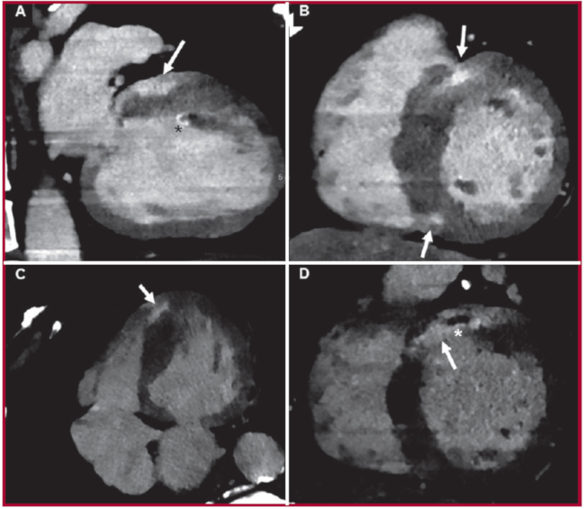 Fase tardía, evaluación espectral monoenergética a 40 keV. (A) Fibrosis subepicárdica anterobasal (flecha) y en nivel del músculo papilar (*), y ausencia de trombosis en orejuela izquierda. (B) Parches intramiocárdicos de fibrosis en nivel anteroseptal e inferoseptal (flechas). (C) Vista de cuatro cámaras con marcada hipertrofia septal, y compromiso apical del ventrículo derecho (flecha). (D). Realce transmural anteroseptal basal, con signos de obstrucción microvascular (*).