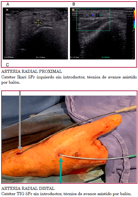 Ecograf&iacute;a vascular de la arteria radial derecha. A. Di&aacute;metro de la arteria radial distal: 2,2 &times; 2,3 mm. B. Di&aacute;metro de la arteria radial proximal: 3,1 &times; 3,2 mm. C. T&eacute;cnica de Bushido. A. Canulaci&oacute;n de la coronaria derecha, cat&eacute;ter Ikari 5Fr izquierdo sin introductor, t&eacute;cnica de avance asistida por bal&oacute;n. B. Canulaci&oacute;n de la coronaria izquierda, cat&eacute;ter TIG 5Fr sin introductor, t&eacute;cnica de avance asistida por bal&oacute;n.