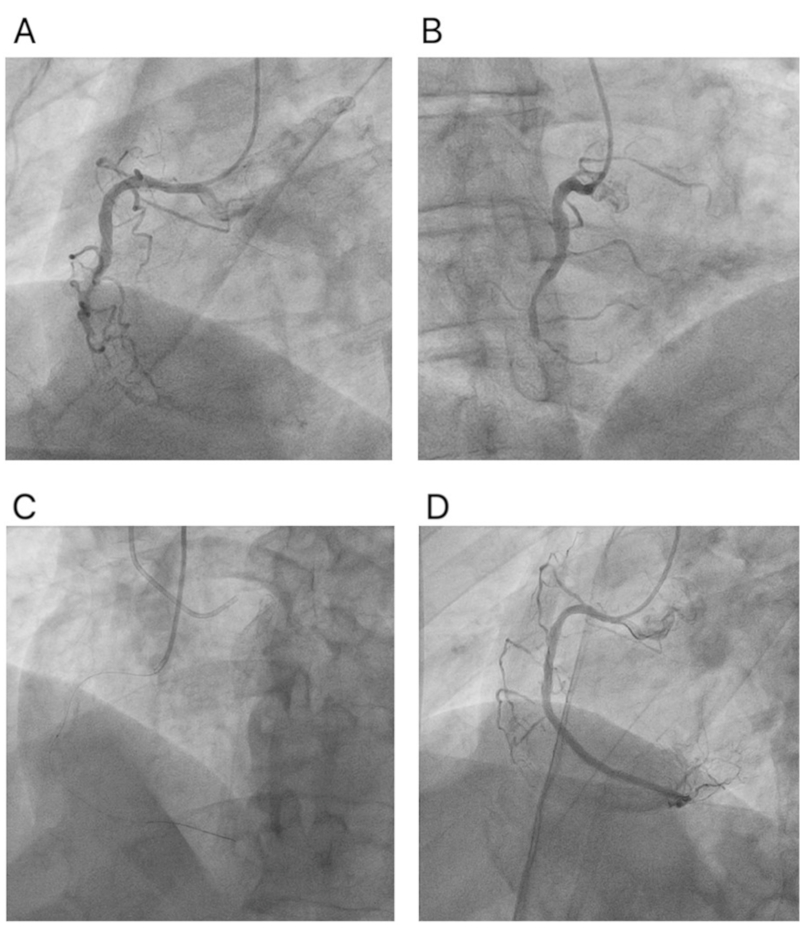 Coronariograf&iacute;a que muestra una oclusi&oacute;n total cr&oacute;nica de la arteria coronaria derecha en el segmento medio, flujo TIMI 0, JCTO: 2 puntos. A. Vista oblicua anterior izquierda de 40&deg;. B. Vista oblicua anterior derecha de 30&deg;. Coronariograf&iacute;a. C. Cruce de OCT con gu&iacute;a coronaria Pilot 150 de 0,014, con soporte de microcat&eacute;ter. D. Angiograf&iacute;a final en proyecci&oacute;n oblicua anterior izquierda de 40&deg; de la arteria coronaria derecha con flujo TIMI 3.