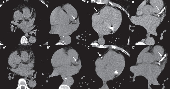 Ejemplos de la concordancia entre la tomografía computarizada cardíaca gatillada (score de calcio coronario, paneles A-D) y la tomografía computarizada de tórax de baja dosis (paneles A’-D’) en pacientes sin calcificaciones (A-A’), con calcificación mínima (B-B’), leve (C-C’), y difusa (DD’).