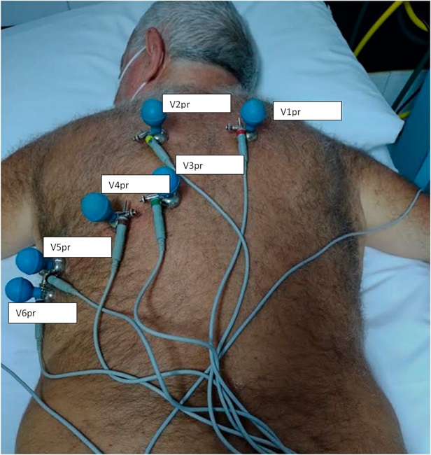 Ubicaci&oacute;n de las derivaciones &ldquo;Pronas&rdquo; en el dorso del paciente