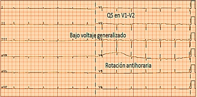 Electrocardiograma en dec&uacute;bito Prono destacando algunas de las caracter&iacute;sticas observadas: bajo voltaje, imagen QS en V1 y V2 y rotaci&oacute;n antihoraria o levo rotaci&oacute;n