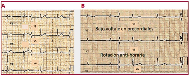 A. derivaciones precordiales en dec&uacute;bito supino. B. derivaciones precordiales en dec&uacute;bito prono