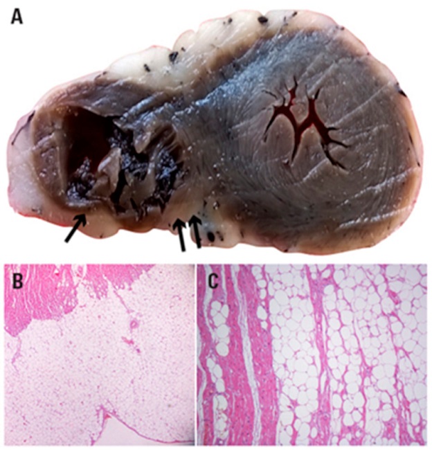 Corte transversal que muestra a la izquierda, ventr&iacute;culo derecho. La pared libre muy adelgazada, que mide 2 a 3 mm de espesor (flecha &uacute;nica). Por debajo abundante tejido graso subepic&aacute;rdico. En el tabique interventricular y el ventr&iacute;culo izquierdo las flechas se&ntilde;alan la infiltraci&oacute;n grasa a ese nivel. B. Extensa presencia grasa subepic&aacute;rdica con infiltraci&oacute;n del miocardio subyacente. C. La infiltraci&oacute;n grasa "diseca" haces mioc&aacute;rdicos atr&oacute;ficos. B y C Tinci&oacute;n con H-E. 100 y 200 X.