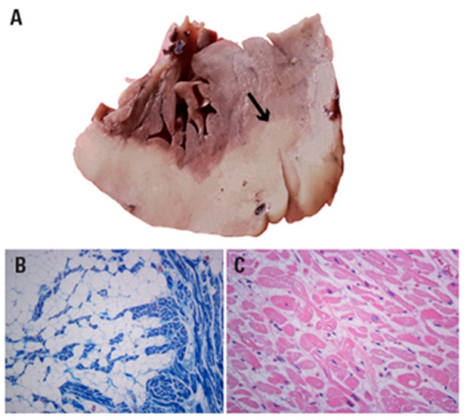 Corte transversal que muestra a la izquierda ventr&iacute;culo derecho. Extensa presencia de grasa subperic&aacute;rdica con infiltraci&oacute;n del miocardio subyacente de ambos ventr&iacute;culos y del tabique interventricular (flecha). B. Extensa presencia de grasa subepic&aacute;rdica con infiltraci&oacute;n del miocardio subyacente. Tricr&oacute;mico de Masson 100 X. C. Secci&oacute;n de pared libre lejana a la infiltraci&oacute;n grasa que se describe en B. Se observan edema intersticial, haces mioc&aacute;rdicos atr&oacute;ficos, con miocitos con discreta infiltraci&oacute;n grasa y alteraciones nucleares. Tinci&oacute;n con H-E 200 X.