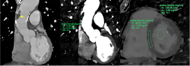 Imagen de TC convencional. A. obtenida simult&aacute;neamente con la TC espectral, donde se evidencia trombo (flecha) a nivel de la porci&oacute;n tubular de la aorta ascendente, asentado sobre ateromatosis a&oacute;rtica difusa. Mediante la utilizaci&oacute;n de mapas de iodo. B. se calcula una concentraci&oacute;n de iodo de 0,15 mg/ml, compatible con trombo. Se calcula adem&aacute;s, un volumen extracelular mioc&aacute;rdico de 29%. C, para un hematocrito de 38%