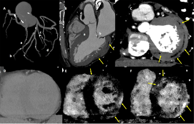 Angiotomograf&iacute;a coronaria. A. Con m&uacute;ltiples lesiones focales y lesiones graves en tercios distales de coronaria derecha (a), descendente anterior (b), diagonal (c), y lateroventricular (d). Vista de 3 c&aacute;maras. B. donde se observa hipertrofia septal (a), engrosamiento valvular mitral (b), y parches de infiltraci&oacute;n grasa intramioc&aacute;rdica a nivel lateral (flechas). Eje corto basal. C. demostrando el infiltrado graso. En la TC convencional en tiempo tard&iacute;o. D. no se identifica realce tard&iacute;o, mientras que utilizando reconstrucciones virtuales monocrom&aacute;ticas a bajos niveles energ&eacute;ticos. E y F. se observan m&uacute;ltiples parches intramioc&aacute;rdicos y subepic&aacute;rdicos de realce tard&iacute;o de contraste (flechas)