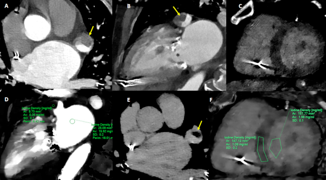 Trombo (flechas) en orejuela izquierda, identificado mediante TC convencional. A y B, y calcificaci&oacute;n difusa de la v&aacute;lvula mitral. *, Adquisici&oacute;n en tiempo tardio utilizando reconstrucciones monoenerg&eacute;ticas a 40 keV, con ausencia de realce tard&iacute;o en miocardio. C. Mediante mapas de iodo. D-F. se resalta la diferencia con la aur&iacute;cula izquierda y la muy escasa concentraci&oacute;n de iodo a nivel del trombo (0,26 mg/ ml). En la adquisici&oacute;n en tiempo tard&iacute;o. E-F, el trombo se discrimina con mayor precisi&oacute;n. E, y se calcula un VEC mioc&aacute;rdico de 35%. F. para un hematocrito de 36%. N&oacute;tese que la presencia de marcapasos y de artefactos de movimiento no impide la detecci&oacute;n del trombo