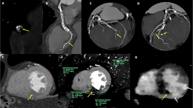 Aneurisma de la arteria coronaria derecha. A y B., con extensa trombosis mural exc&eacute;ntrica. flecha A. La rama descendente posterior presenta una lesi&oacute;n oclusiva (flecha B). Reconstrucciones en &ldquo;globo&rdquo;. C y D. que demuestran ateromatosis difusa del &aacute;rbol coronario incluidas lesiones oclusivas en la rama lateroventricular. C. y la rama diagonal. D. En la TC convencional. E. se observa una muy sutil hipodensidad mioc&aacute;rdica inferoseptal (flecha), mientras que las imagenes espectrales con mapas de iodo permite detectar hipoperfusi&oacute;n grave inferoseptal. Flecha F. con una concentraci&oacute;n de iodo de apenas 0,05 mg/ml, e hipoperfusi&oacute;n leve (1,87 mg/ml) a nivel inferior e inferolateral. En la adquisici&oacute;n en tiempo tard&iacute;o G. Se evidencia realce predominantemente transmural inferior e inferolateral (flechas blancas) y una zona negra (flecha amarilla) compatible con obstrucci&oacute;n microvascular/&rdquo;no reflow&rdquo;