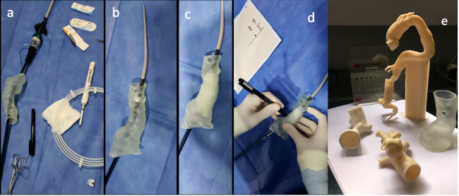 Distintos materiales y pasos necesarios para confeccionar una fenestración en un paciente con las arterias renales a nivel del cuello proximal, en plan de colocación de una endoprótesis fenestrada (a-d). Algunos modelos de impresión 3D (e), fabricados con distintas finalidades (fenestraciones, información a pacientes, táctica quirúrgica).