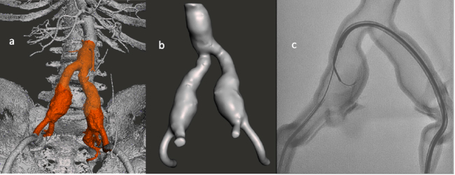 Imagen tomográfica (a) de la cual se extrae la impresión 3D (b). Se utiliza dicha impresión para el entrenamiento en colocación de endoprótesis ramificada ilíaca (c).