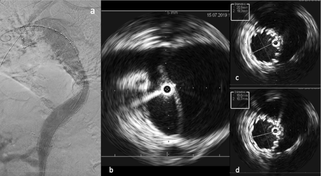 Imagen de ecografía intravascular. Angiografía final que demuestra la exclusión de la falsa luz en un paciente con una disección aórtica tipo B (a). Las imágenes por IVUS muestran, que la guía por donde debe viajar la endoprótesis, se encuentra en la luz verdadera (b) y además, que la luz verdadera se expande a lo largo de varios segmentos segmentos de la aorta, luego de colocada la endoprótesis que ocluye el orificio de entrada de la disección (c-d).