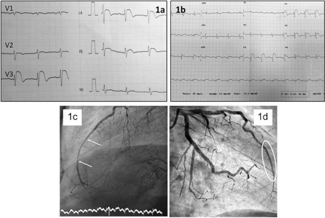 a. ECG basal: Supradesnivel del segmento ST en V2 a V4. b. ECG al alta hospitalaria: Supradesnivel del segmento ST en V3 a V6. Onda Q en V3. Mínimo supradesnivel del segmento ST en D2-D3-avF. c. Angiografía de la arteria descendente anterior izquierda antes del tratamiento. d. Imagen tras el implante del stent
