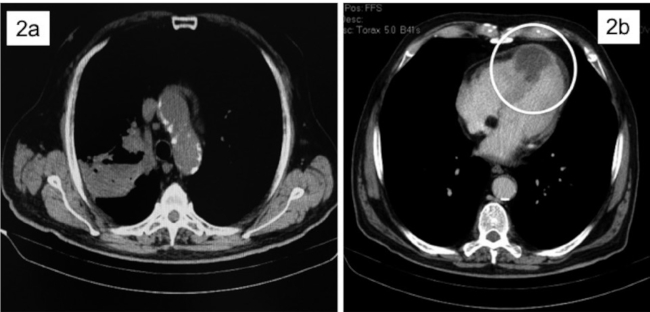 Tomografía computarizada. 2a. Cáncer de pulmón en el lóbulo superior derecho. 2b. Infiltración miocárdica en el ápex y el tabique interventricular