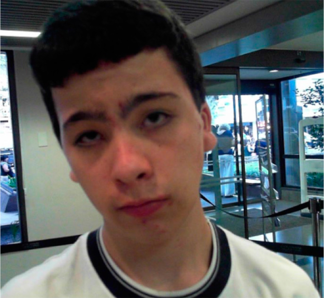 Fenotipo de s&iacute;ndrome de Noonan