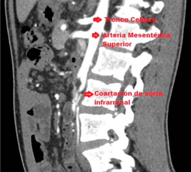 Corte sagital de angiotomograf&iacute;a preoperatoria con coartaci&oacute;n de aorta infrarrenal