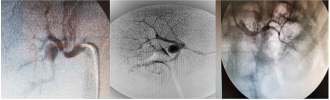A y B. Arteriograf&iacute;a selectiva de la arteria renal derecha, donde se muestra una imagen sacular, con poco caudal, adyacente a la bifurcaci&oacute;n principal de la misma ateria, hallazgos espec&iacute;ficos de un aneurisma de la arteria renal derecha y C. Estenosis de arteria principal renal izquierda