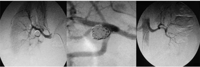 A y B. Arteriograf&iacute;a selectiva de la arteria renal derecha, donde se muestra Embolizaci&oacute;n del aneurisma mediante 5 coils Barricade y C. Angioplastia de artgeria renal izquierda