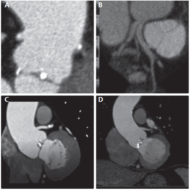 Anomal&iacute;as coronarias detectadas en la TC en pacientes con VAB. De izquierda a derecha y de arriba a abajo: A: Origen alto del tronco de la coronaria izquierda y de la coronaria derecha por encima de union sinotubular. B: Origen independiente de la arteria descendente anterior y la circunfleja. C y D: Origen alto del tronco de la coronaria izquierda en pacientes con calcificaci&oacute;n de la v&aacute;lvula a&oacute;rtica bic&uacute;spide. Abreviaturas: VAB: v&aacute;lvula a&oacute;rtica bic&uacute;spide, TC: tomograf&iacute;a computarizada card&iacute;aca