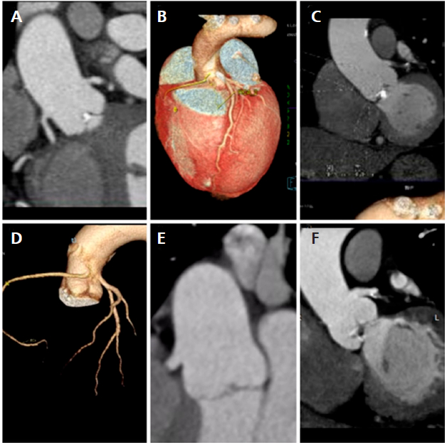 Anomal&iacute;as coronarias detectadas en la TC en pacientes con VAB. De izquierda a derecha y de arriba a abajo: A: Origen alto de la arteria coronaria derecha y del tronco de la coronaria izquierda con calcificaci&oacute;n valvular bic&uacute;spide. B: Reconstrucci&oacute;n tridimensional de la aorta y las arterias coronarias que muestra una arteria coronaria derecha que surge anteromedial al seno coronario izquierdo como un vaso independiente con trayecto interarterial. C: Origen alto y angulado del tronco de la coronaria izquierda. D: Reconstrucci&oacute;n (volume rendering) que demuestra una anomal&iacute;a del origen de la arteria coronaria derecha que surge del seno de Valsalva izquierdo, con trayecto interarterial. E: Origen alto de la arteria coronaria derecha. F: Origen alto del tronco de la coronaria izquierda. Abreviaturas:TC: Tomograf&iacute;a computarizada card&iacute;aca; VAB: V&aacute;lvula a&oacute;rtica bic&uacute;spide.