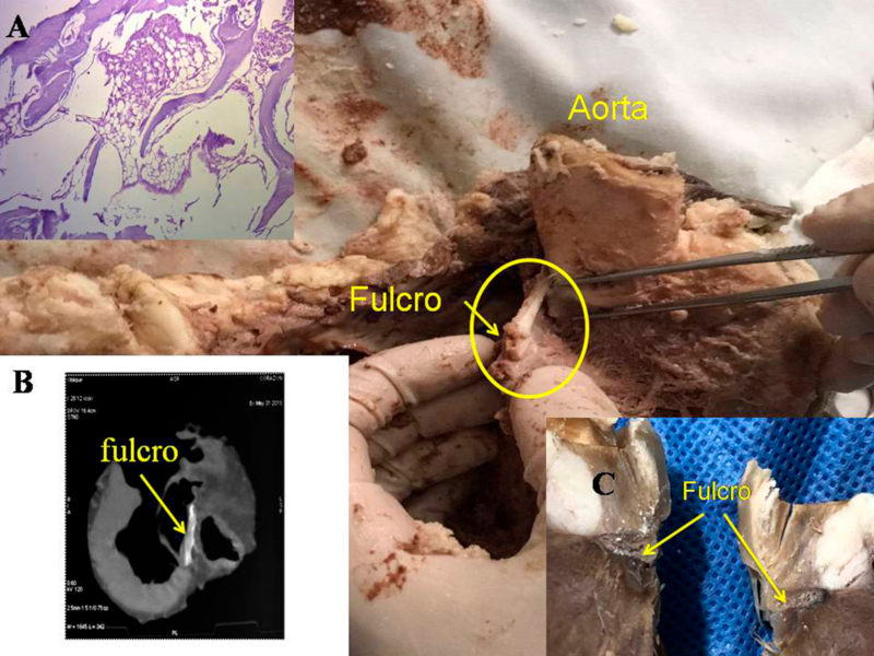 Fulcro card&iacute;aco (coraz&oacute;n bovino). A. Trab&eacute;cula &oacute;sea madura que configure el tejido del fulcro card&iacute;aco. T&eacute;cnica de hematoxilina-eosina (10x); B. En el &aacute;rea se&ntilde;alada con la flecha se observa imagen adyacente a la ra&iacute;z a&oacute;rtica sobre el septum interventricular (tomograf&iacute;a computada); C. Otra vista del fulcro.