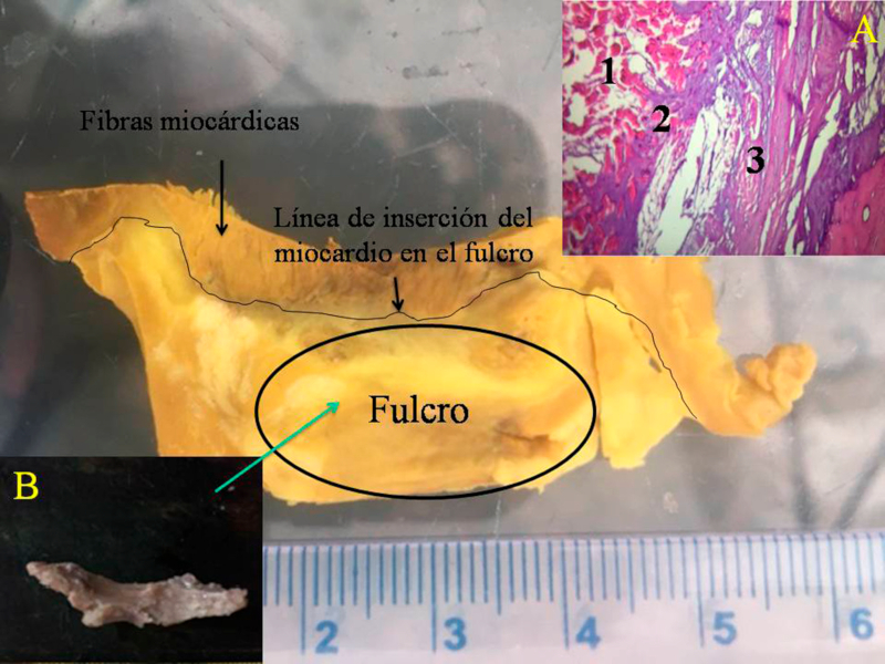 Obs&eacute;rvese la l&iacute;nea de inserci&oacute;n de las fibras mioc&aacute;rdicas en el fulcro de un coraz&oacute;n bovino. Histolog&iacute;a de la inserci&oacute;n (A). 1. Fibras mioc&aacute;rdicas y estroma mixoide. 2. Cintas mioc&aacute;rdicas en un estroma condroide (inserci&oacute;n). 3. Tejido cortical &oacute;seo del fulcro. T&eacute;cnica hematoxilina-eosina(15x). B. pieza resecada.