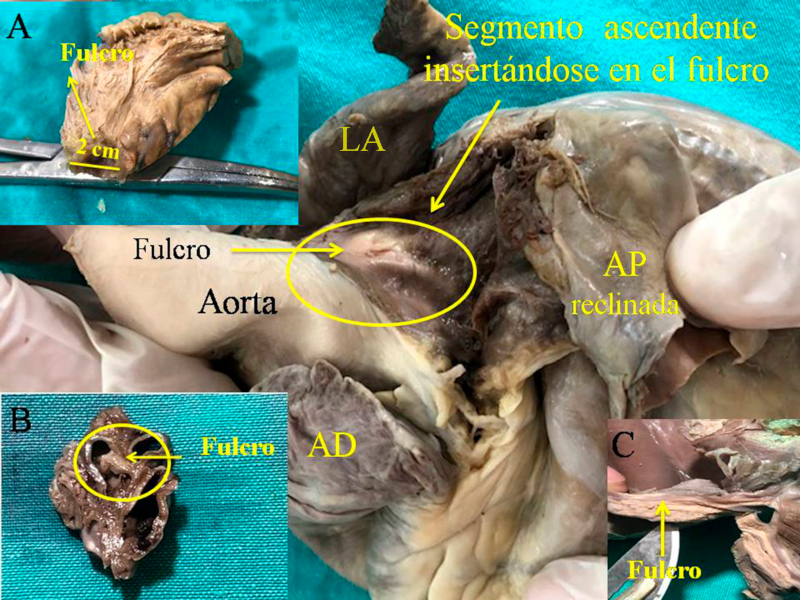 Fulcro card&iacute;aco (coraz&oacute;n humano). A. 10 a&ntilde;os de edad; B. Embri&oacute;n humano de 23 semanas de gestaci&oacute;n; C. Fulcro resecado perteneciente a un coraz&oacute;n humano adulto.