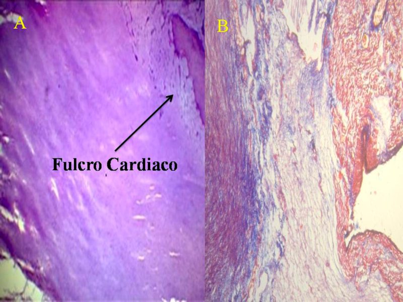 A. Coraz&oacute;n humano de 10 a&ntilde;os de edad. Zona central: &aacute;rea del fulcro formada por tejido condroideo. T&eacute;cnica hematoxilina-eosina (15x). B. Areas azuladas precondroideas en un estroma mixoide en feto de 23 semanas de gestaci&oacute;n. T&eacute;cnica tricr&oacute;mica de Masson (15x).