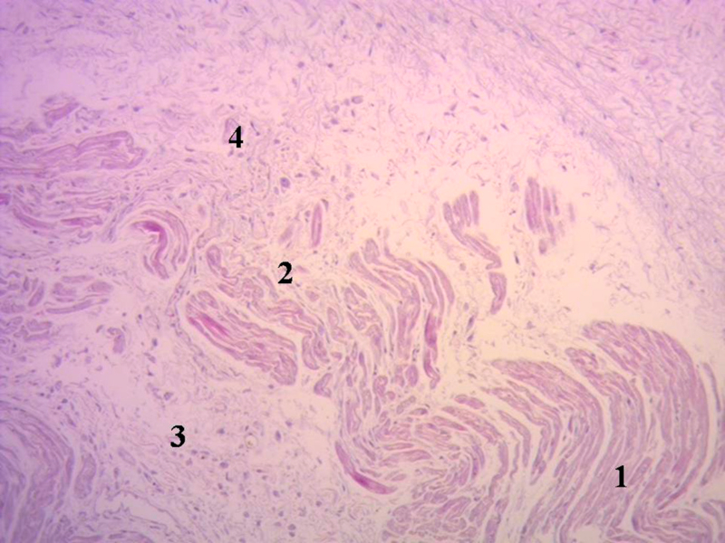 Miocardiocitos festoneados penetrando en una matriz fibrocol&aacute;gena (coraz&oacute;n humano adulto). 1. Miocardiocitos, 2. Deshilachamiento de miocardiocitos; 3. Miocardiocitos atr&oacute;ficos, 4. Matriz fibrocol&aacute;gena. T&eacute;cnica hematoxilina-eosina (15x).
