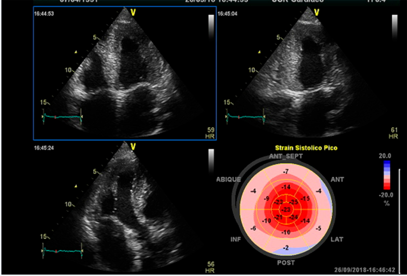 Implante y programaci&oacute;n de DAVI HM3 como terapia de destino