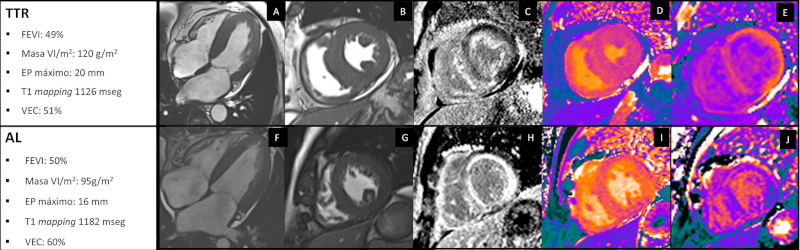 Resonancia magn&eacute;tica card&iacute;aca en pacientes con amiloidosis TTR y AL. Fila de arriba: Paciente con amiloidosis TTR. Fila de abajo: Paciente amiloidosis AL. Los dos varones, con similar compromiso de la funci&oacute;n sist&oacute;lica ventricular. La amiloidosis TTR con m&aacute;s incremento de la masa ventricular y espesores que la amiloidosis AL, la amiloidosis AL con un VEC algo mayor. El T1 mapping fue similar en los dos pacientes. En la fila superior: A y B) im&aacute;genes de cinerresonancia en vistas de cuatro c&aacute;maras y eje corto medial; C) imagen de realce tard&iacute;o de gadolinio con realce subendoc&aacute;rdico; D) imagen de T1 mapping nativo; E) imagen de T1 mapping posgadolinio. En la fila inferior; F y G) im&aacute;genes de cinerresonancia en vistas de cuatro c&aacute;maras y eje corto medial; H) imagen de realce tard&iacute;o de gadolinio con realce subendoc&aacute;rdico; I) imagen de T1 mapping nativo; J) imagen de T1 mapping posgadolinio.