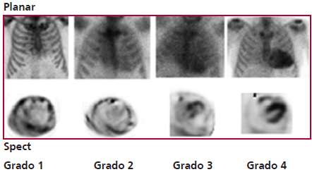 An&aacute;lisis Semicuantitativo de la captaci&oacute;n de 99mTc-HMDP: Im&aacute;genes planares y SPECT