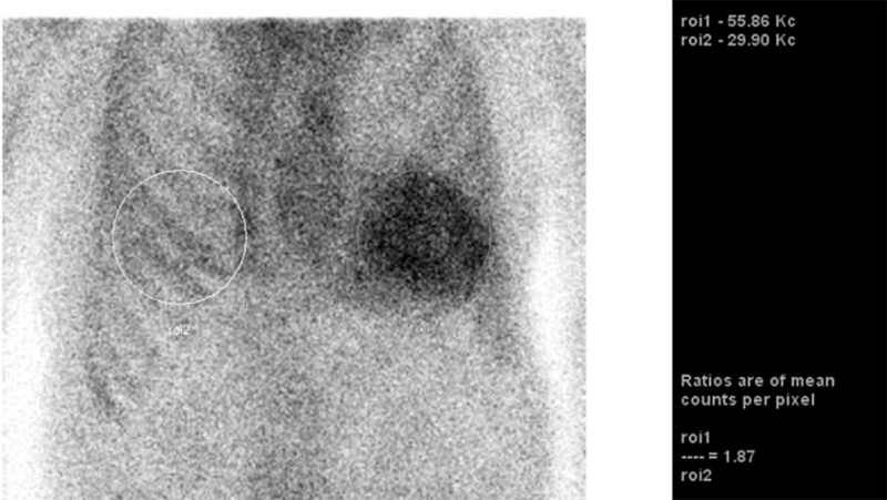 An&aacute;lisis cuantitativo: Ejemplo de cuantificaci&oacute;n de la captaci&oacute;n card&iacute;aca del 99mTc- PYP por medio de la relaci&oacute;n de cuentas entre el coraz&oacute;n y el pulm&oacute;n contralateral (H/CL)