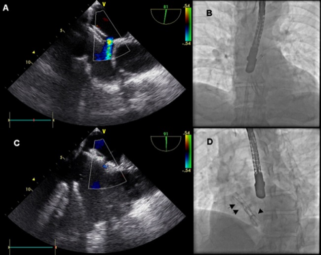 (A) Imagen de ecocardiograma transesof&aacute;gico en vista 90&deg; con ligera angulaci&oacute;n craneal. Se observa dispositivo de foramen oval permeable liberado sin ocluir adecuadamente la comunicaci&oacute;n interauricular residual. (B) Imagen de radioscopia. Dispositivo de foramen oval permeable liberado y vaina a trav&eacute;s del defecto residual anterosuperior. (C) Imagen de ecocardiograma transesof&aacute;gico. Ambos dispositivos con ausencia de cortocircuitos residuales. (D) Imagen de radioscopia. Ambos dispositivos liberados con t&eacute;cnica de &ldquo;sandwich&rdquo;. Dispositivo de comunicaci&oacute;n interauricular (flecha doble) abrazando el dispositivo de foramen oval permeable (flecha simple).