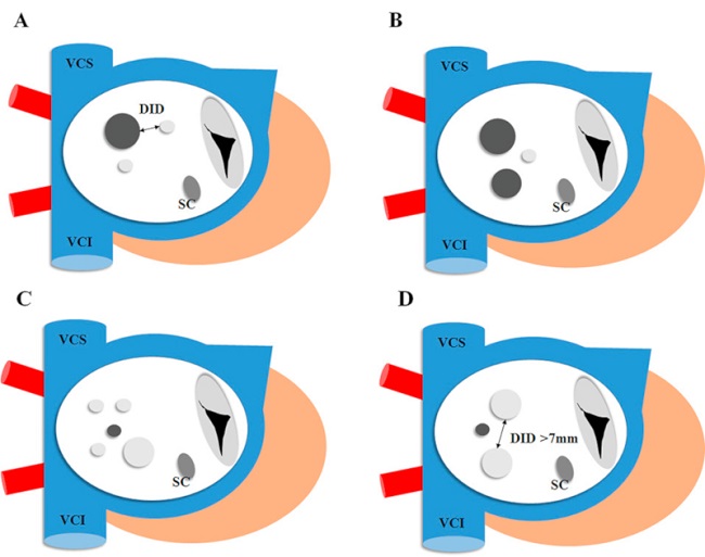 Clasificaci&oacute;n de defectos m&uacute;ltiples. Tipo A: defecto grande acompa&ntilde;ado de otros peque&ntilde;os con diferentes distancias interdefectos (DID). Tipo B: defecto grande junto a otro moderado Tipo C: septum interauricular cribiforme con 5 o m&aacute;s defectos. Tipo D: defectos peque&ntilde;os y moderados con DID igual o mayor a 7 mm. Los defectos m&aacute;s oscuros son los que deber&iacute;an elegirse para implantar el dispositivo. Defecto grande (&ge;15 mm), moderado (5-14 mm) y peque&ntilde;o (<5 mm). Seno coronario (SC). Adaptado de Farhaj Z y col 3.