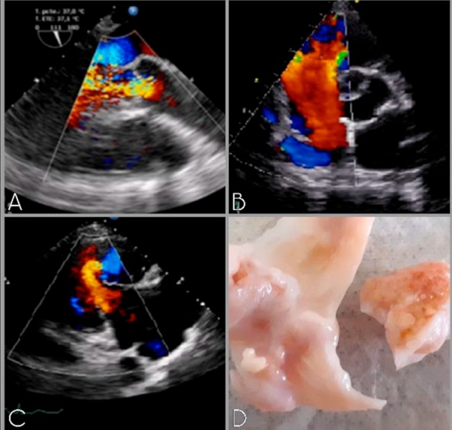 A. Insuficiencia tric&uacute;spidea libre; B. Insuficiencia pulmonar grave; C. Insuficiencia aortica moderada. D; Macroscop&iacute;a de V&aacute;lvula Aortica, valvas engrosadas y retra&iacute;das.