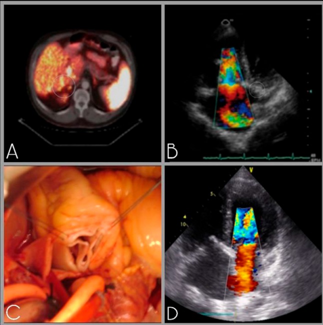 A. PET, patr&oacute;n difuso de afectaci&oacute;n hep&aacute;tica; B. Insuficiencia Tric&uacute;sp&iacute;dea grave; C. Imagen Intraoperatoria de V&aacute;lvula Pulmonar. D. Insuficiencia mitral grave