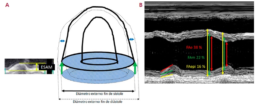 Representaci&oacute;n gr&aacute;fica del ventr&iacute;culo izquierdo en fin de di&aacute;stole (l&iacute;neas de puntos) y fin de s&iacute;stole (l&iacute;neas continuas). El acortamiento longitudinal (AL) est&aacute; representado por el movimiento de base a punta (flechas verdes) de un te&oacute;rico cilindro que actuar&iacute;a como un pist&oacute;n, ya que el &aacute;pex permanece inm&oacute;vil. A la izquierda se observa el registro de la excursi&oacute;n sist&oacute;lica del anillo mitral (ESAM) lateral registrado con modo M desde la vista de 4 c&aacute;maras. El acortamiento circunferencial (AC), que se representa con las flechas azules, debido a la incompresibilidad del miocardio contribuye al engrosamiento de la pared; sin embargo se debe mencionar que el AL por s&iacute; mismo ya determina parte del engrosamiento parietal por la misma causa (incompresibilidad del miocardio). 1B. Modo M a nivel medio ventricular en el que se representan las fracciones de acortamiento epic&aacute;rdica (FAepi) en color amarillo, mesoparietal (FAm) en verde y endoc&aacute;rdica (FAe) en rojo. La FAepi es la &uacute;nica que depende del AC mientras que la FAm y FAe est&aacute;n determinadas por el AC y el AL.