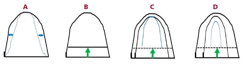 Representaci&oacute;n del ventr&iacute;culo izquierdo (VI) en fin de di&aacute;stole (negro) y fin de s&iacute;stole (azul). En A el VI tiene un espesor parietal m&iacute;nimo y se representa el acortamiento circunferencial (AC) aislado, y en B el acortamiento longitudinal (AL) aislado. En el C el miocardio es de espesor normal y presenta solo AL, observ&aacute;ndose el engrosamiento parietal sist&oacute;lico que determina la eyecci&oacute;n del VS. En D el VI tiene hipertrofia conc&eacute;ntrica, lo cual para un mismo AL ocasiona una mayor excursi&oacute;n del endocardio, que redunda en mayor fracci&oacute;n de eyecci&oacute;n, evidenciando la dependencia de este &uacute;ltimo &iacute;ndice de la geometr&iacute;a ventricular. En C y D el VS es el mismo ya que la excursi&oacute;n del anillo mitral es similar.